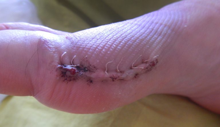 Do Bunion Surgery articles like this really work?