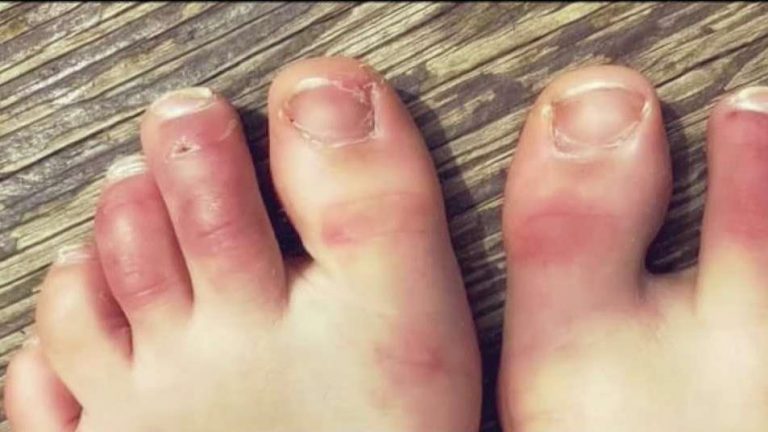 No Podiatrists. Nobody cares about COVID toes.