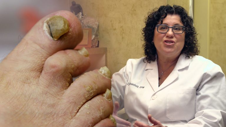 A Podiatrist went on Vice as a Toenail Fungus Expert