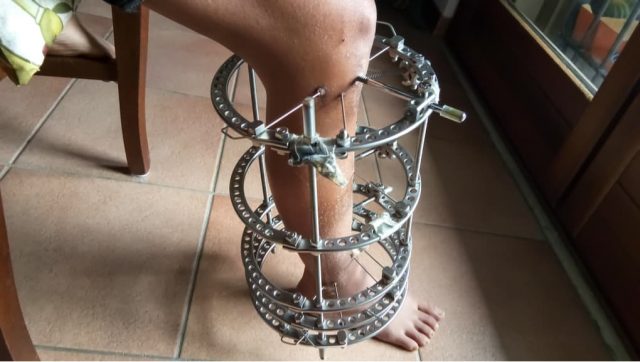 A Patient Dies with an External Fixator Applied