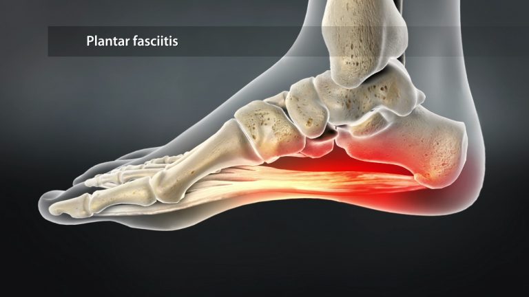 Plantar Fasciitis is now the most common foot disorder that physicians treat