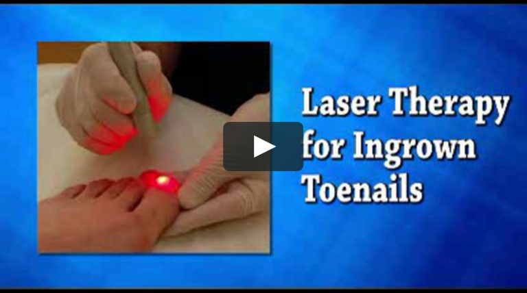 Why in 2021 are Podiatrists promoting laser toenail surgery?